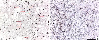 SMARCB1/INI1 loss in skull base conventional chordomas: a clinicopathological and molecular analysis